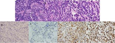 Trastuzumab deruxtecan effectively controlled recurrent ovarian large-cell neuroendocrine carcinoma with low-level HER-2 expression: a case report